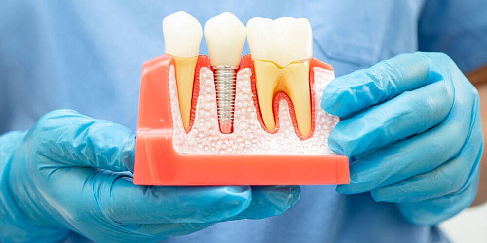 Dental Implants